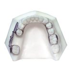 Mesial Jet
